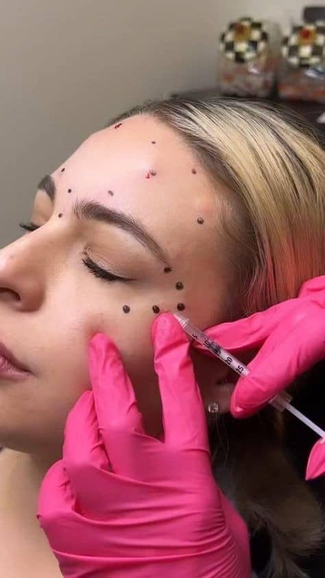 Addressing Worries: Do Fillers Damage Your Face?