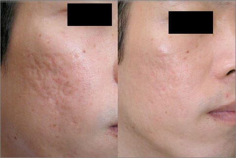 Can Dermal Fillers Improve Acne Scars?