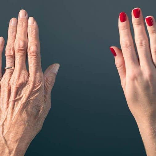Dermal Fillers for Hand Rejuvenation: A Growing Trend