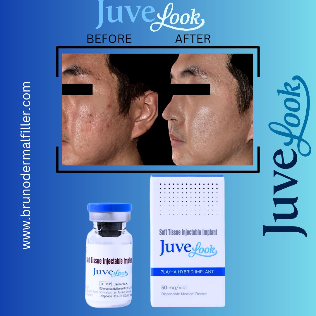 Discover the Magic of Juvelook: The Unique Soft Tissue Injectable Impl ...