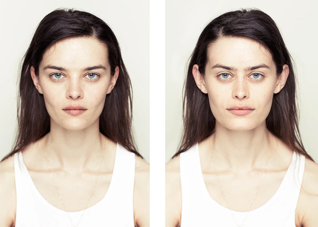 How Fillers Help Create a Symmetrical, Balanced Face