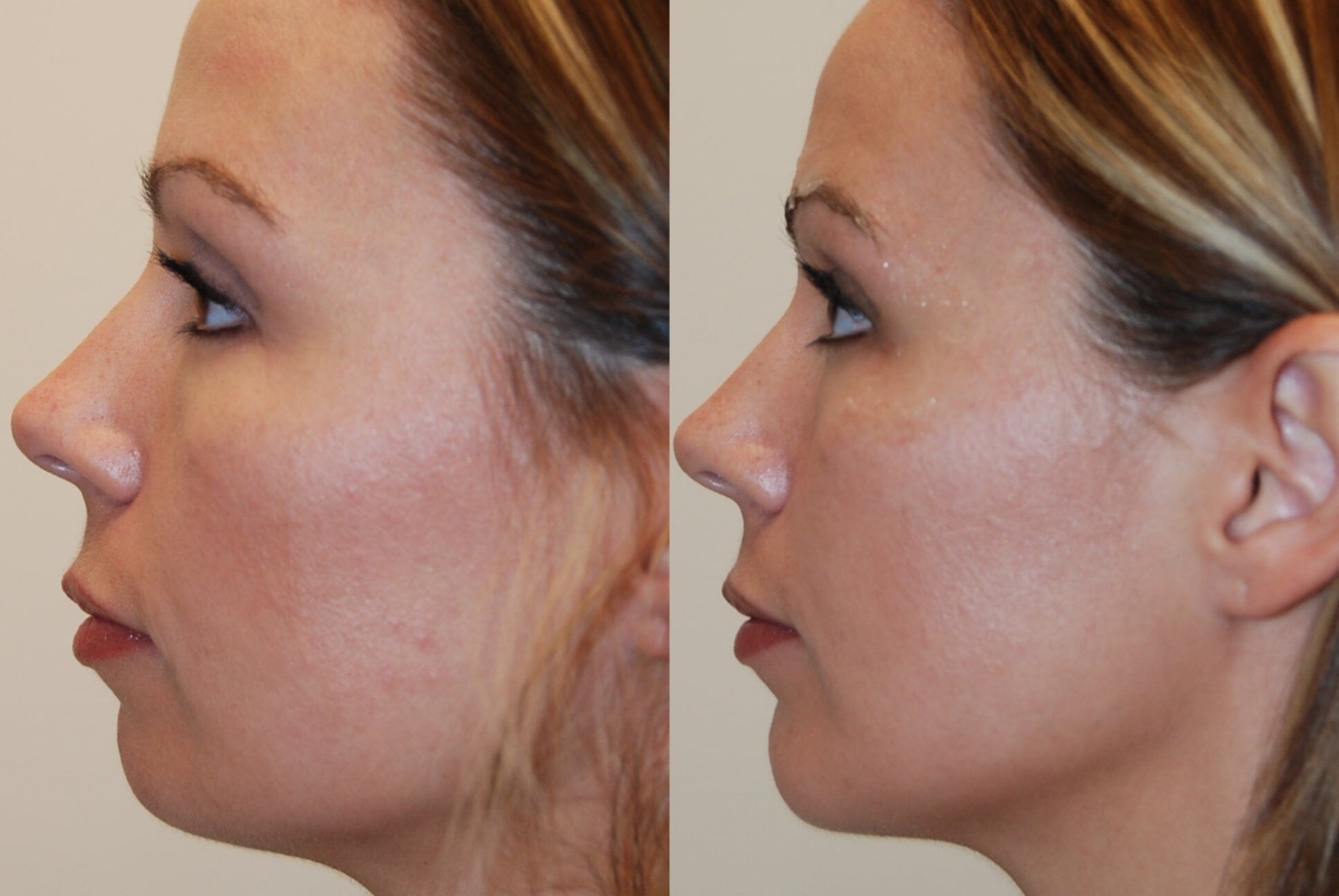 The Benefits of Chin Augmentation with Dermal Fillers