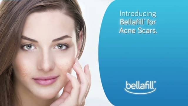 The Long-Lasting Results of Bellafill: What Makes it a Popular Choice for Acne Scar Treatment