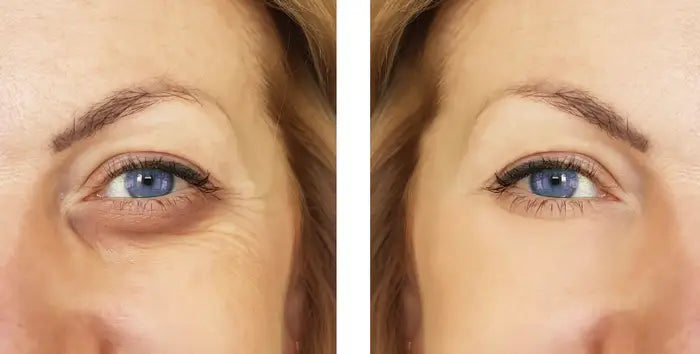 The Magic of Under-Eye Fillers: Say Goodbye to Tired Eyes