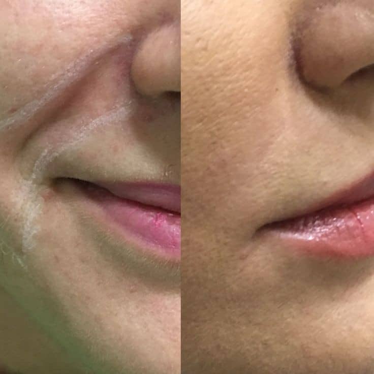 Viscosity in fillers
