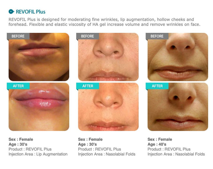 REVOFIL PLUS brunodermalfiller.com 