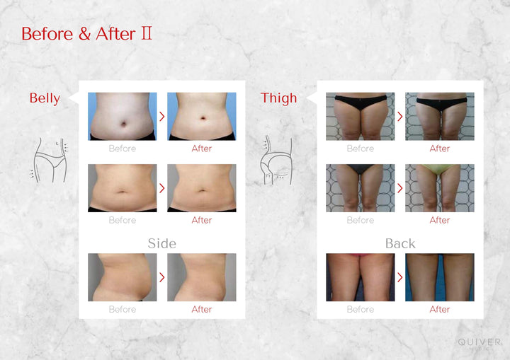 SLIM POINT BODY brunodermalfiller.com 