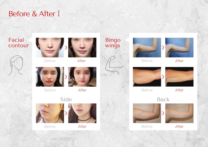 SLIM POINT BODY brunodermalfiller.com 